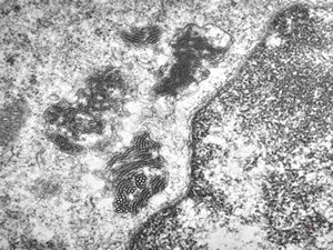 M,18y. | tubuloreticular complex in lymphocyte - unclassified hematologic disorder